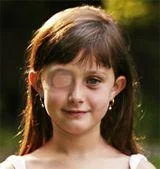 vision therapy amblyopia